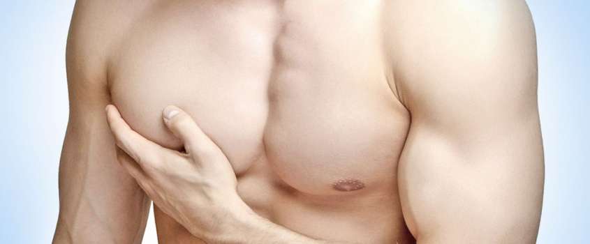 gynecomastia