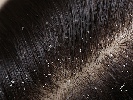 Dandruff: Natural Solutions Against